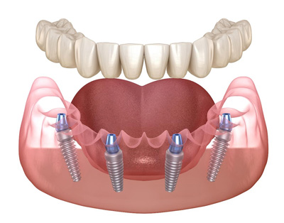 An image of a dental implant with screws and brackets attached to a tooth, showcasing the surgical process.