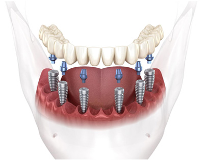 The image displays a close-up view of a human mouth with teeth and gums, featuring dental implants with visible screws and bolts, surrounded by transparent plastic.