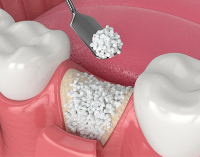 An image of a dental implant procedure, showing a screw and white powder being inserted into the socket of a missing tooth.