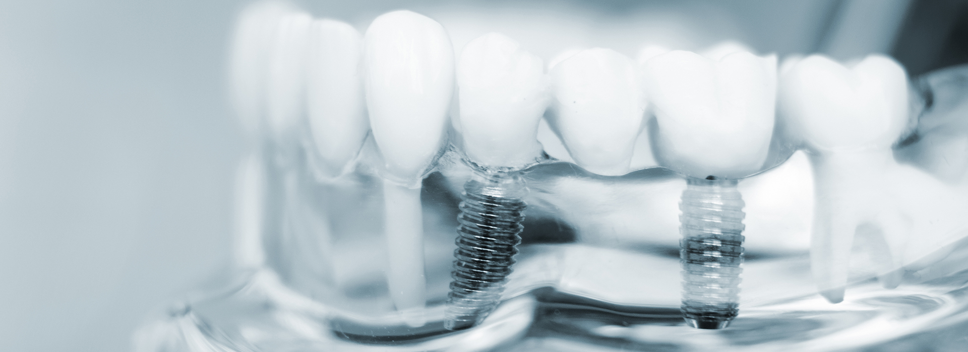 The image shows a close-up of multiple dental implants with visible screws, set against a blurred background that appears to be a mouth or teeth.