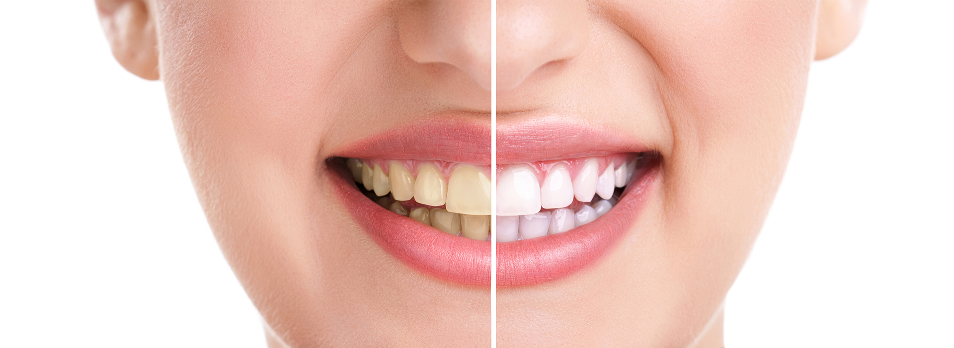 The image shows a close-up of a person s face with a smile, featuring teeth whitening before and after treatment.